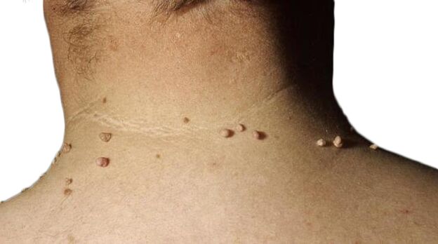 Papillomas on the neck - the result of viral defeat