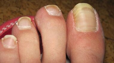 How's the fungus on the nails itself