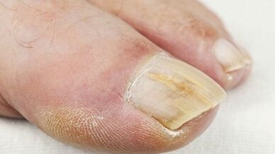 The early stages of fungal development on the nails
