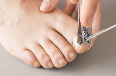Causes of fungus on nails