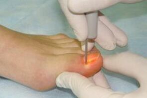 mechanical removal of nails for fungal infections