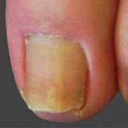 yeast infection on nails