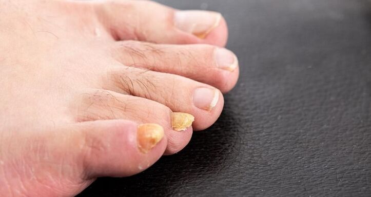 yellow nails due to foot fungus
