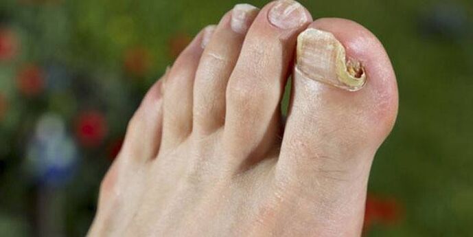 toenail fungus