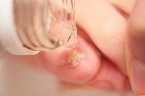 Apple cider vinegar for nail fungus