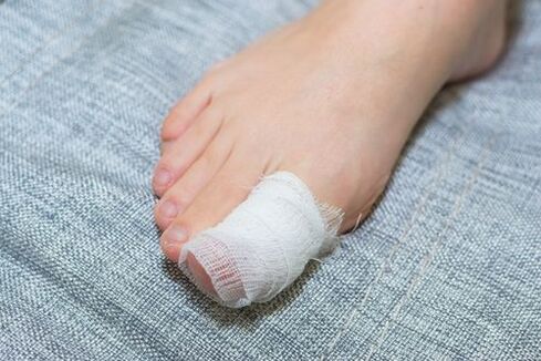 Apple cider vinegar lotion for nail fungus