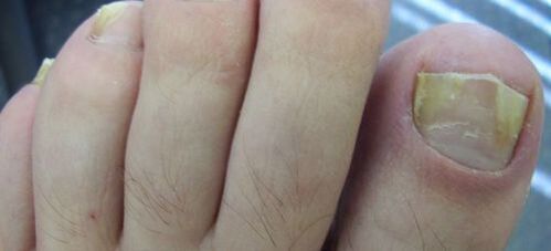 symptoms of nail fungus and its treatment with vinegar