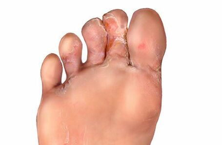 symptoms of fungus between the toes