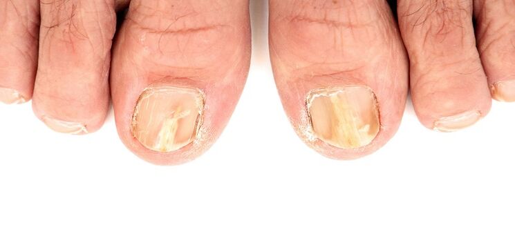 damage to the nail plate by fungus