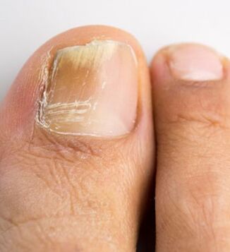 Nail fungus on the big toe, which occurs against a background of weakened immunity