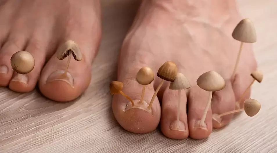 A fungal infection that affects the toenails