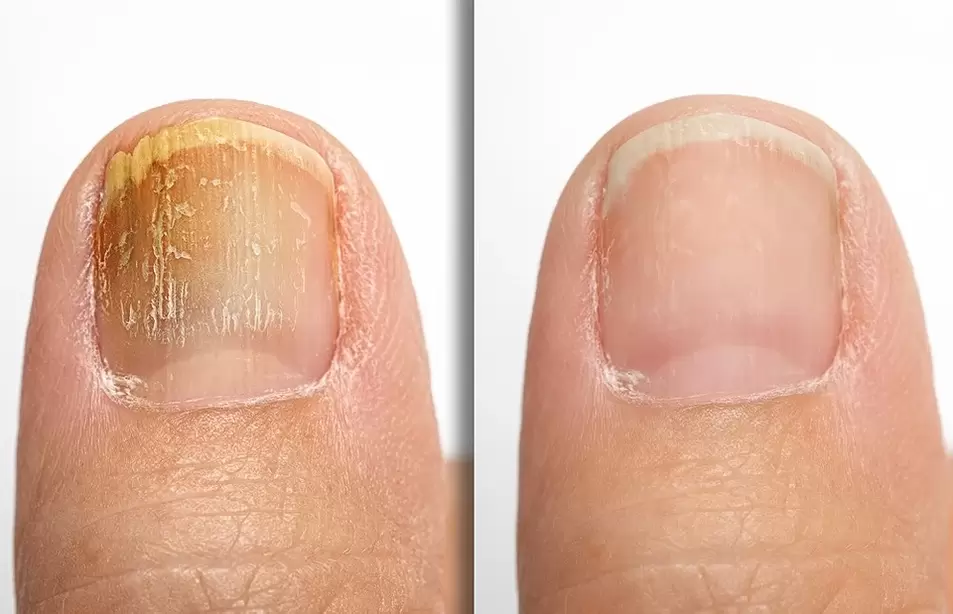 Nails with signs of fungus (left) and healthy nails (right)