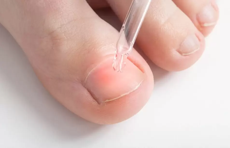 Treatment of onychomycosis with antifungal solutions