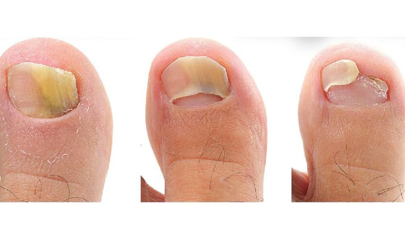 type of toenail fungus