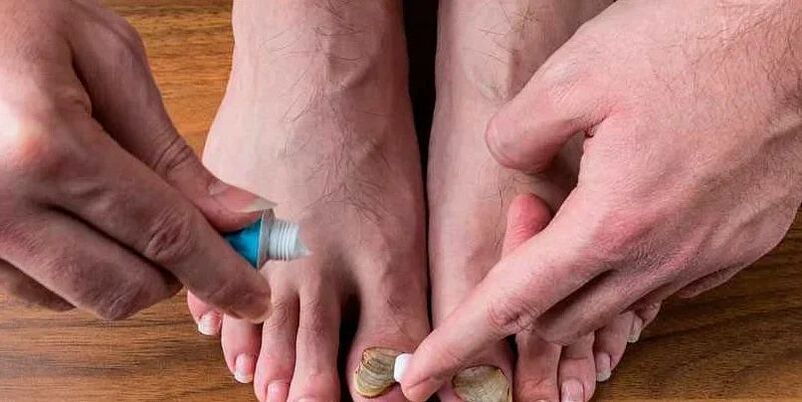 the cause of fungus between the toes