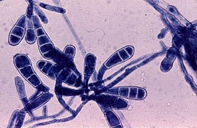 Bacteria cause nail fungus