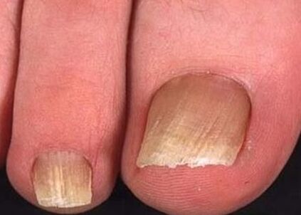 Nail fungus on the feet of the early stage