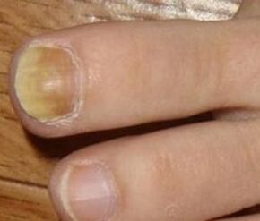 Symptoms of early stage of nail fungus